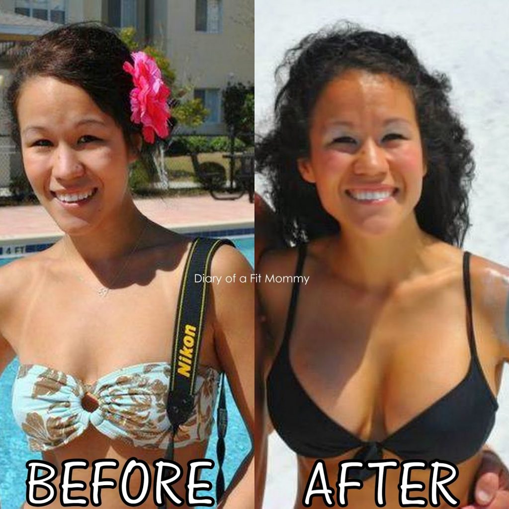 Breast Implants Before and After Pregnancy