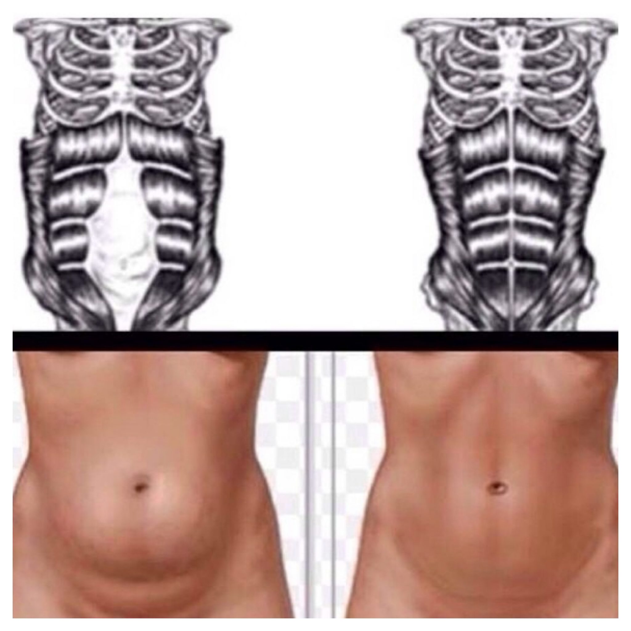 Diastasis recti, (Abdominal Muscle Separation) – Belly Bands