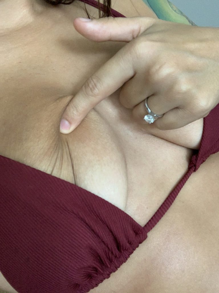 Breast Implant Illness: One Month Post Op Update - Diary of a Fit