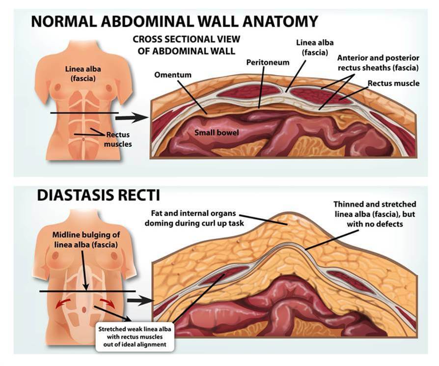 How to Improve Diastasis Recti After Baby